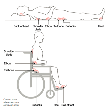 Top diagram highlights the potential pressure sore areas at the back of head, shoulder blade, elbow, tailbone, buttocks and the heel on a person lying flat on the bed.